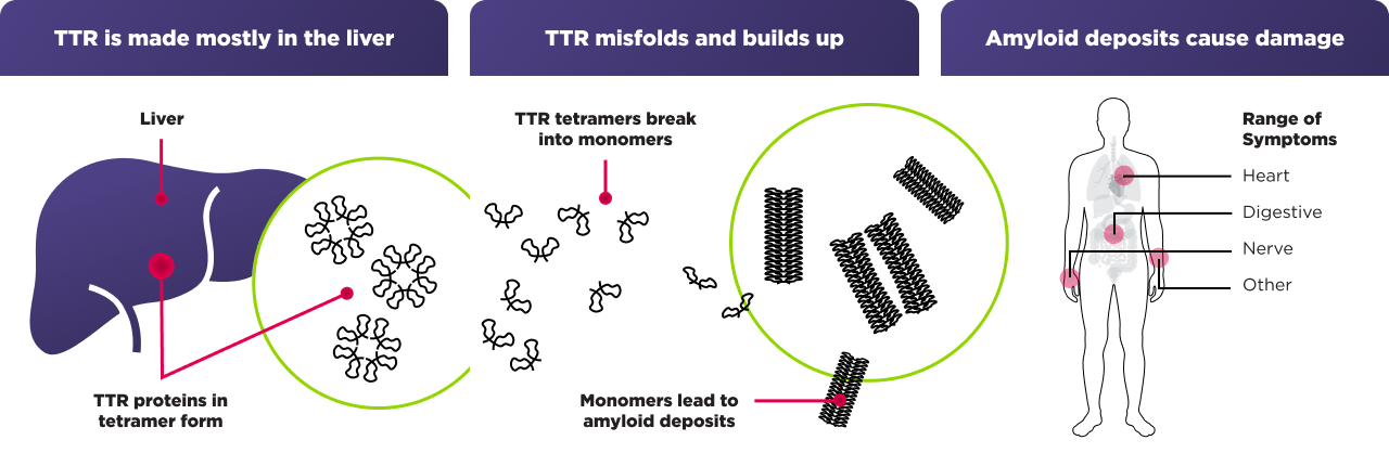 Chart showing how AMVUTTRA limits TTR production in the liver